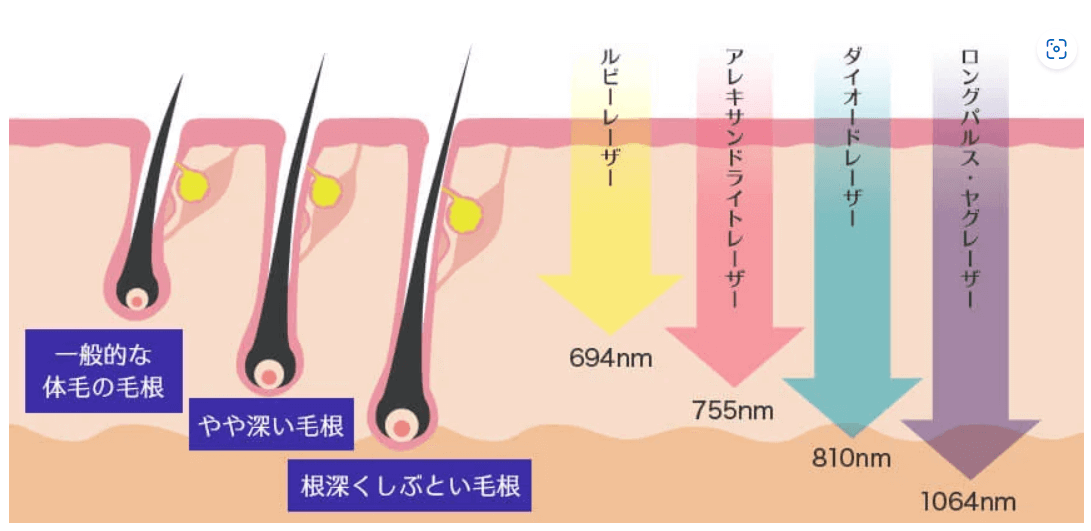 ビューティースキンクリニックのレーザー各種の波長(=脱毛効果の高さ)の説明